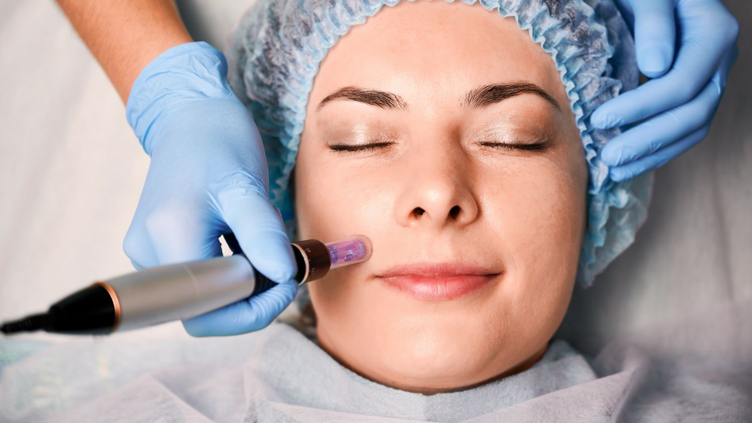 Anti-Aging Microneedling at Pacific Beach Acupuncture and Wellness