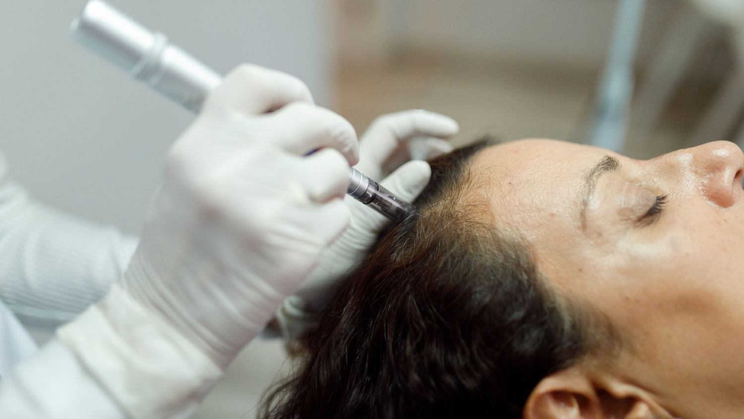 Microneedling For Hair Loss