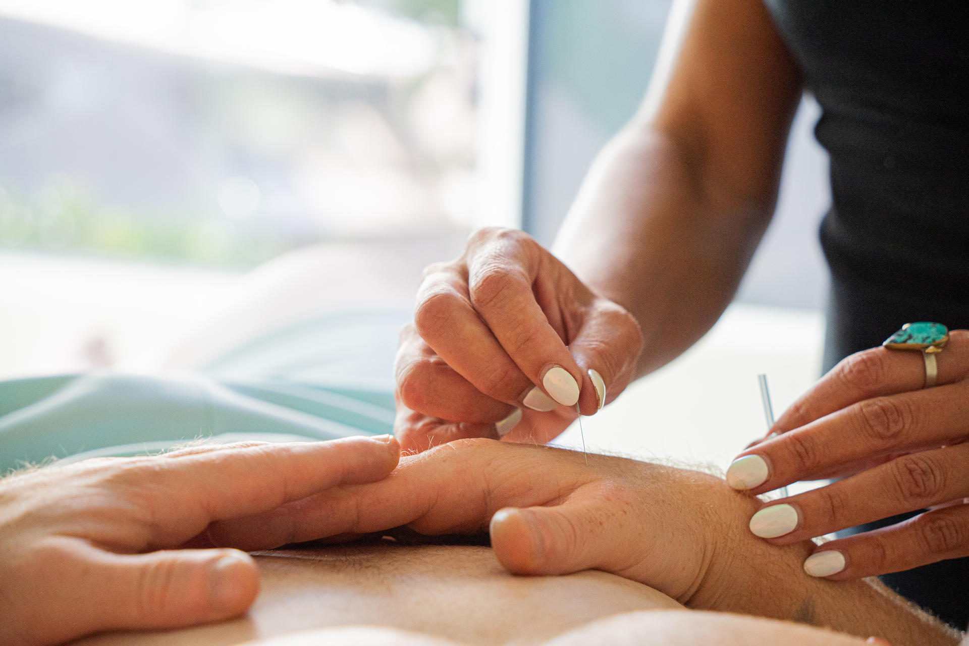 acupuncture can help with neuropathy by increasing circulation and reducing pain