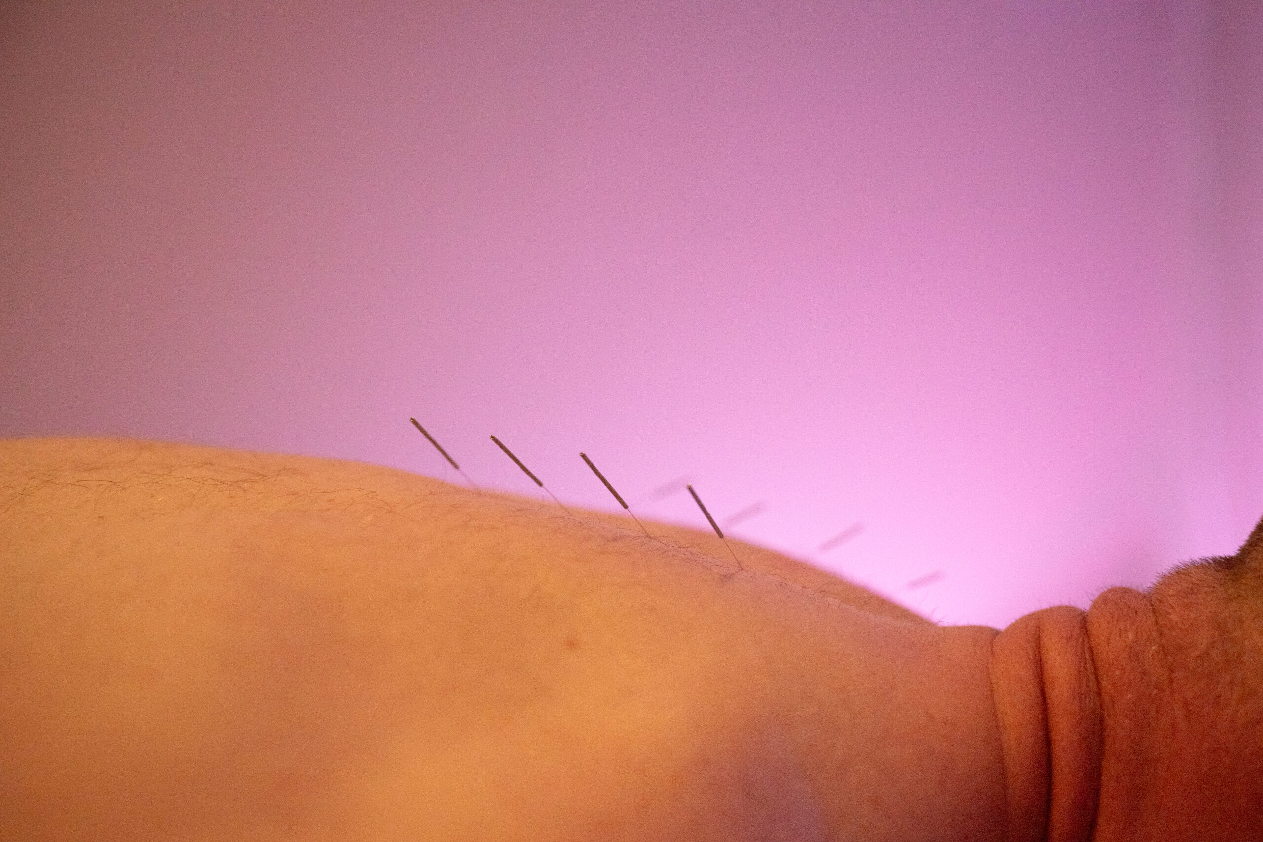 getting regular acupuncture prevents illness